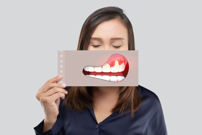 Mujer con foto del efecto de periodontitis