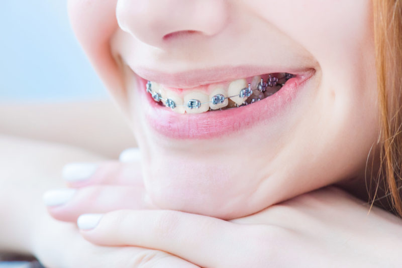 Niña sonriendo con braquets